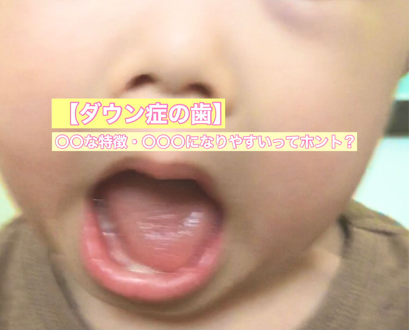 ダウン症の歯の特徴や生え始め時期は 歯並びと虫歯の注意点 It S Show Down